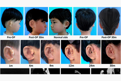 биоимпланты уши